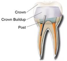 root canal treatment