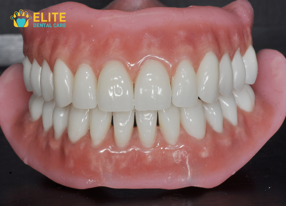 Bio Functional Prosthetic System(BPS) Dentures Fixing – Elite Dental Care Tracy