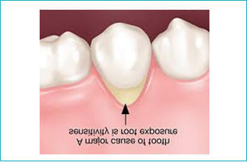 Common Causes of Sensitive Teeth1