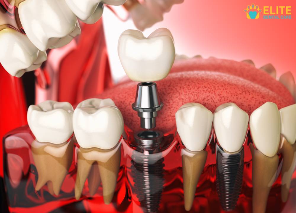 Dental Implant And How Crucial Replacing Teeth – Elite Dental Care Tracy
