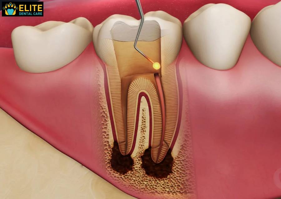 Filling the Root Canal – Elite Dental Care Tracy