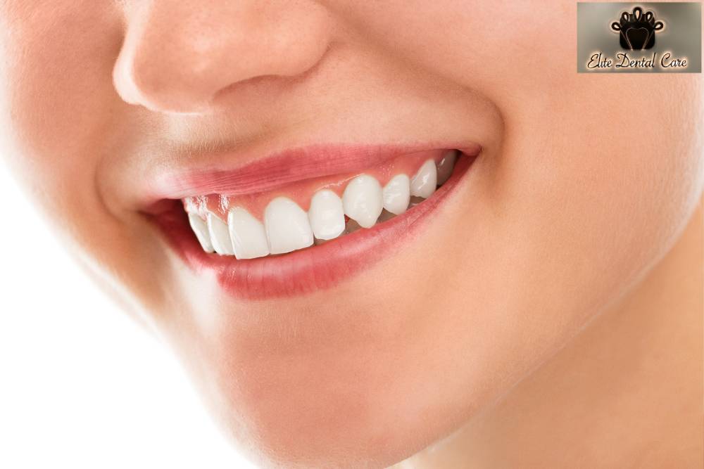 Best Food for Healthy Teeth – Elite Dental Care Tracy