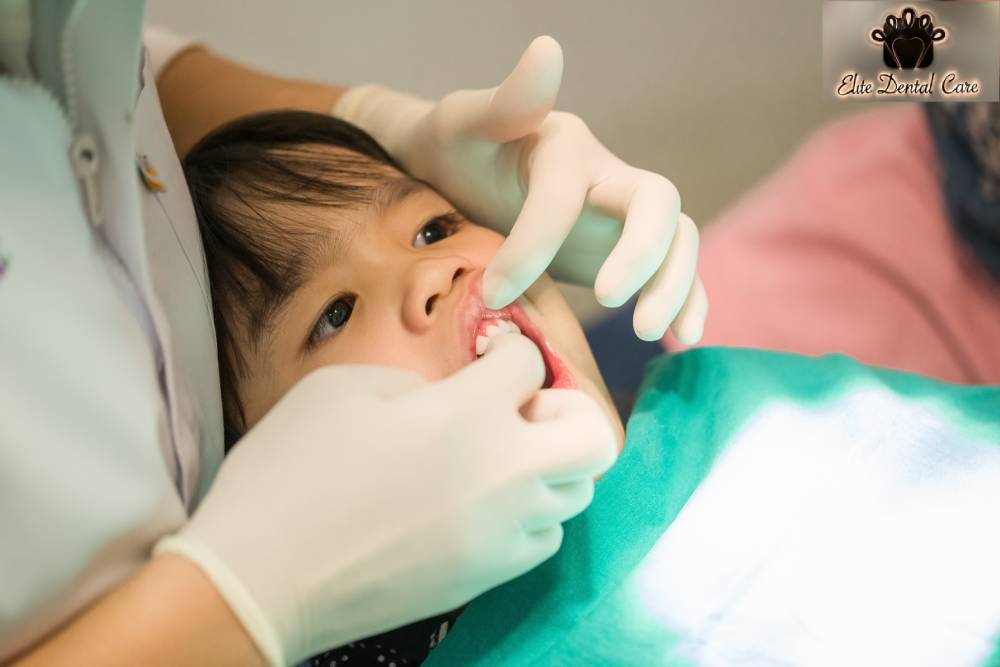 The Importance of Fluoride for Your Teeth – Elite Dental Care Tracy