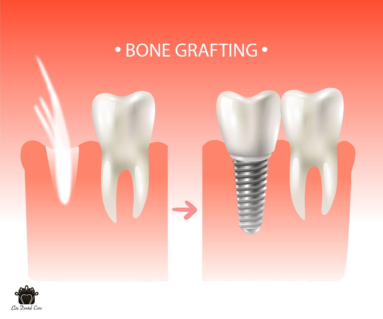 Dental Bone Grafting – Elite Dental Care Tracy