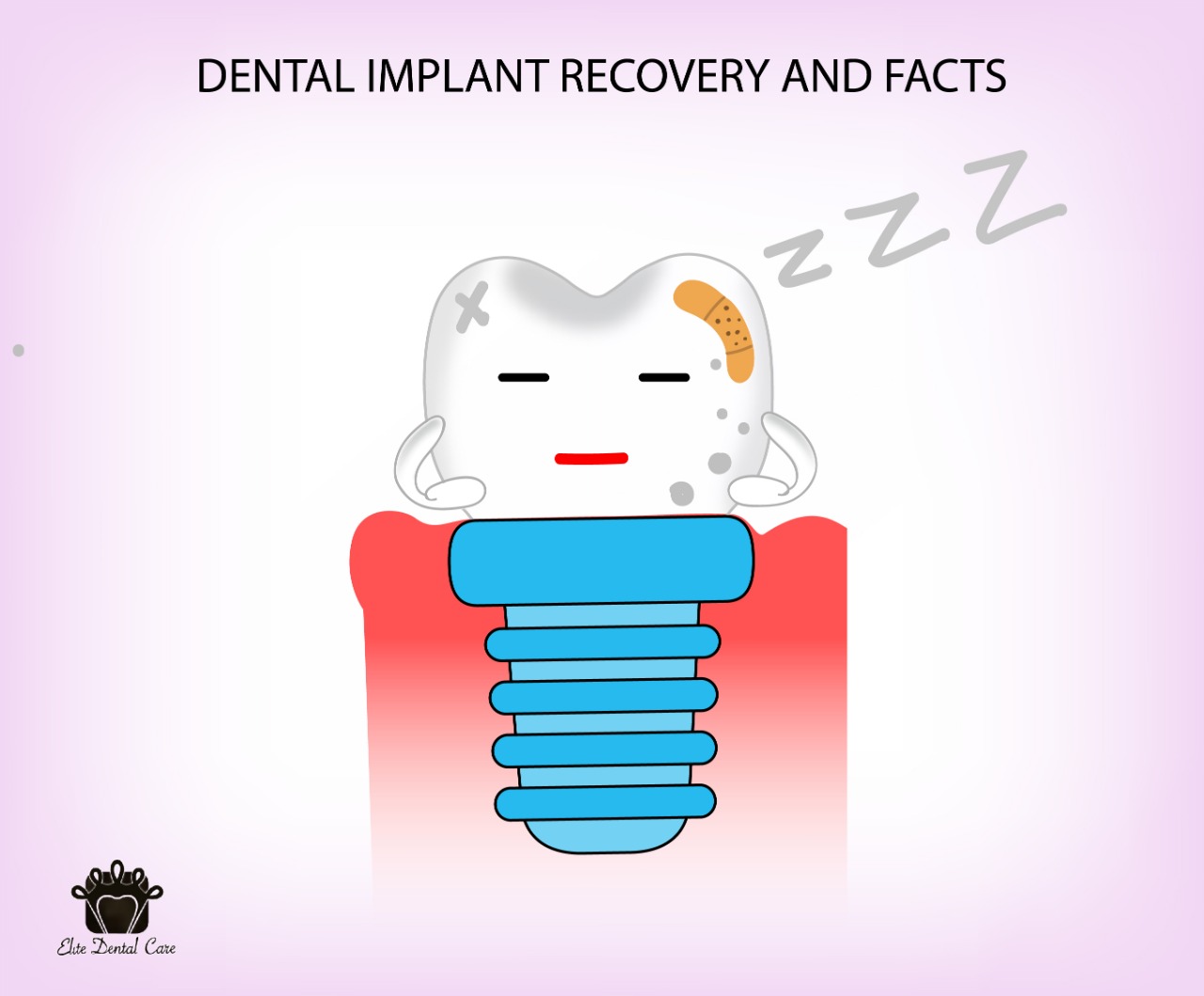 Dental Implants Recovery and Facts – Elite Dental Care Tracy