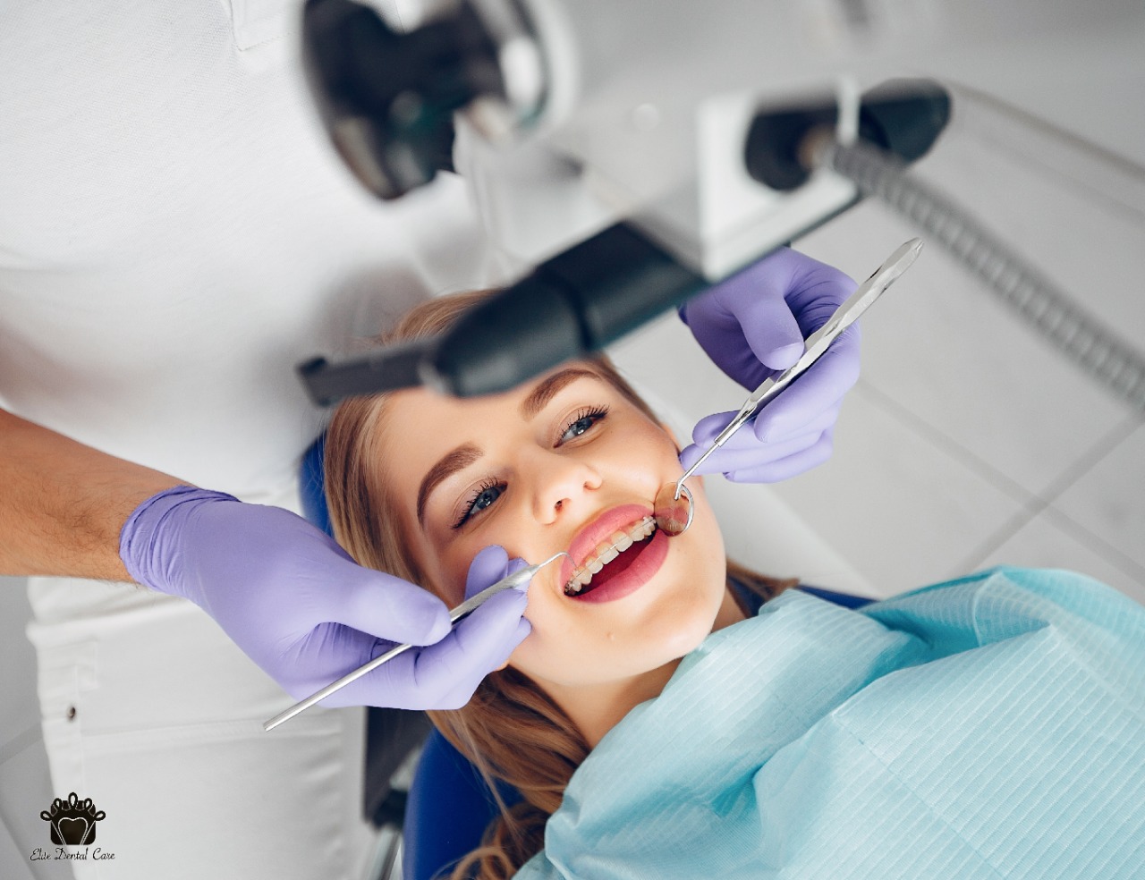 Why are Dental Fillings Necessary – Elite Dental Care Tracy