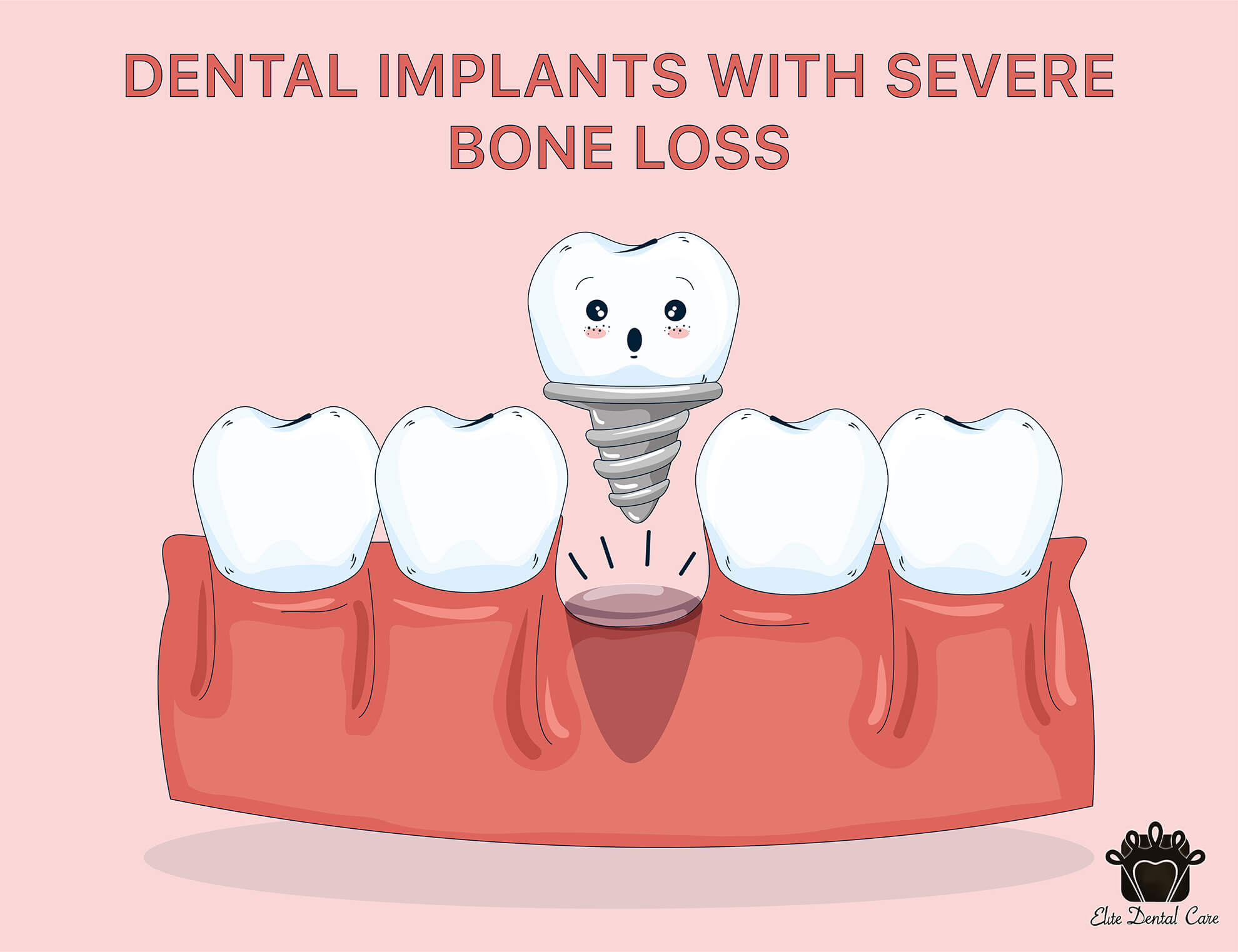 Dental Implants with Bone Loss – Elite Dental Care Tracy
