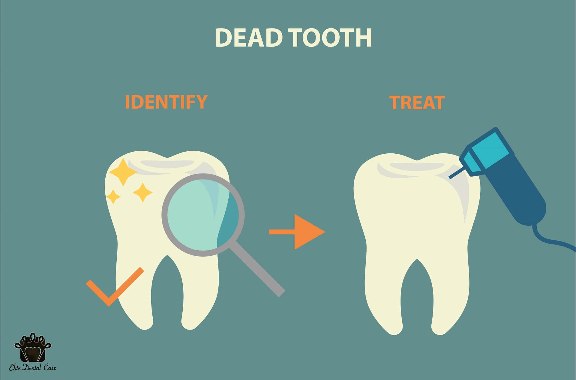 Identifying and Treating a Dead Tooth – Elite Dental Care Tracy