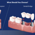 Dental Implants v/s Dental Bridges – Elite Dental Care Tracy