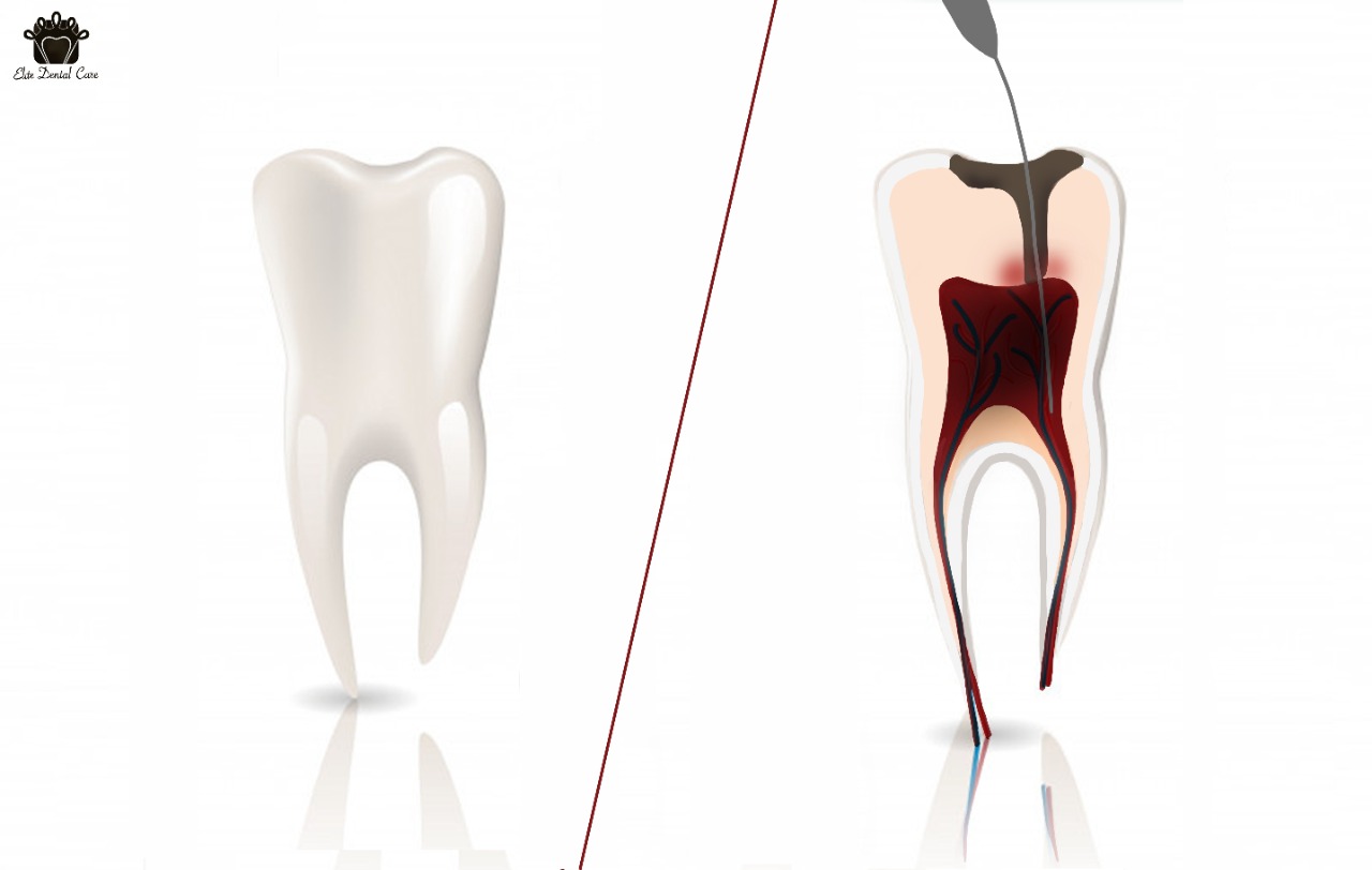 How to Know If You Need a Root Canal – Elite Dental Care Tracy
