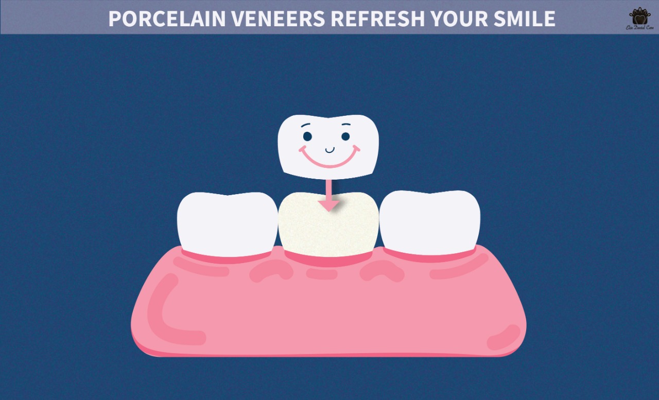 Porcelain Veneers Refresh Your Smile – Elite Dental Care Tracy