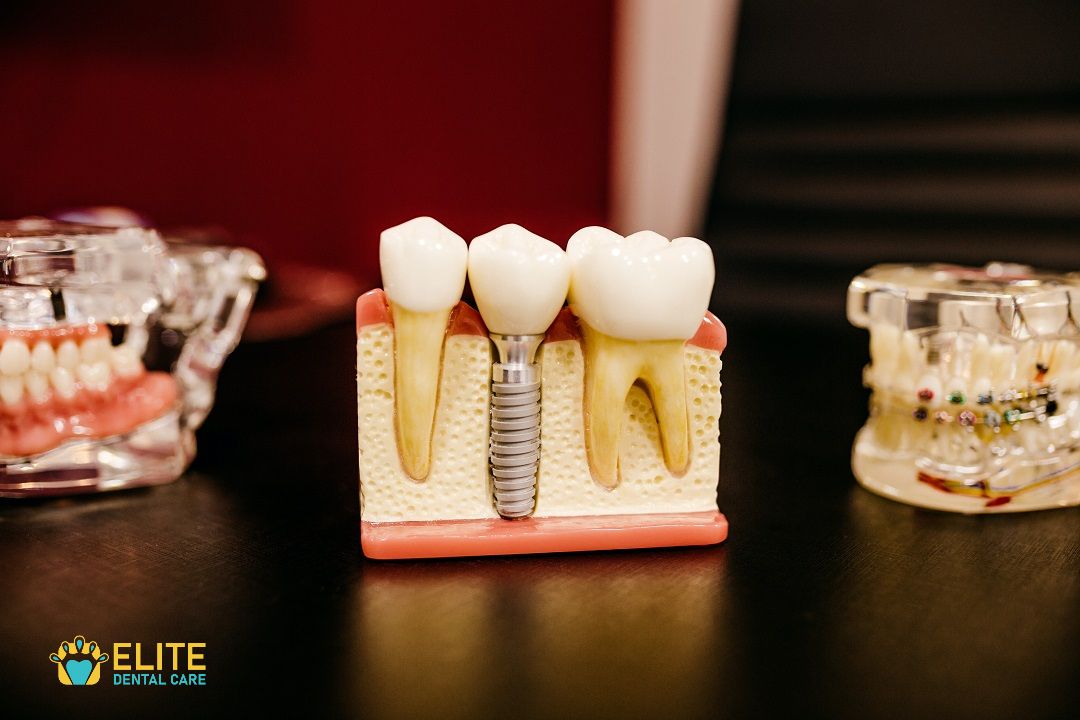 SAVE YOUR TEETH WITH ROOT CANAL TREATMENT – ELITE DENTAL CARE TRACY