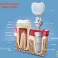 IMPLANT PROSTHETIC DENTISTRY – ELITE DENTAL CARE, TRACY