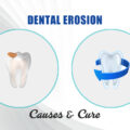 DENTAL EROSION: CAUSES AND CURE – ELITE DENTAL CARE TRACY