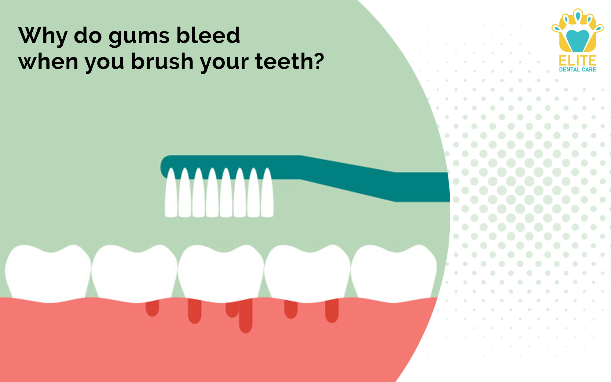 WHY DO GUMS BLEED WHEN YOU BRUSH YOUR TEETH? – ELITE DENTAL CARE TRACY