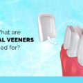 WHAT ARE DENTAL VENEERS USED FOR?