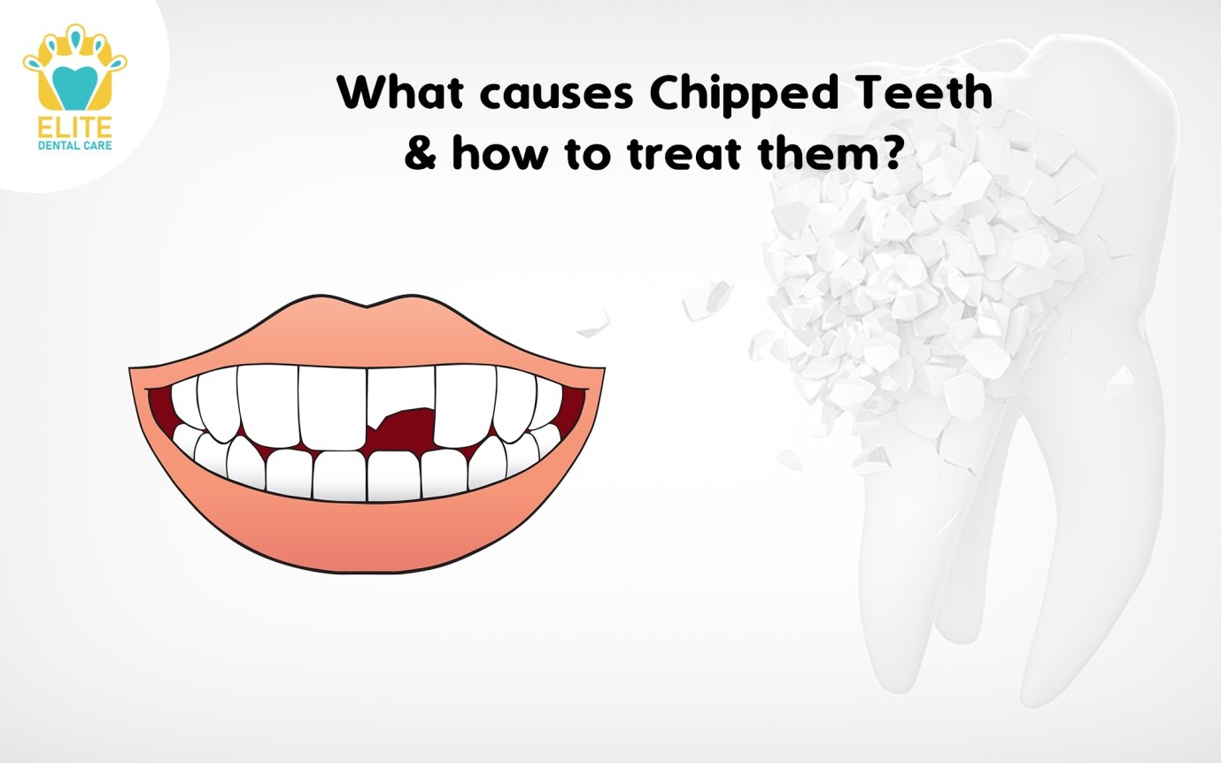 CHIPPED TEETH: CAUSES & TREATMENT