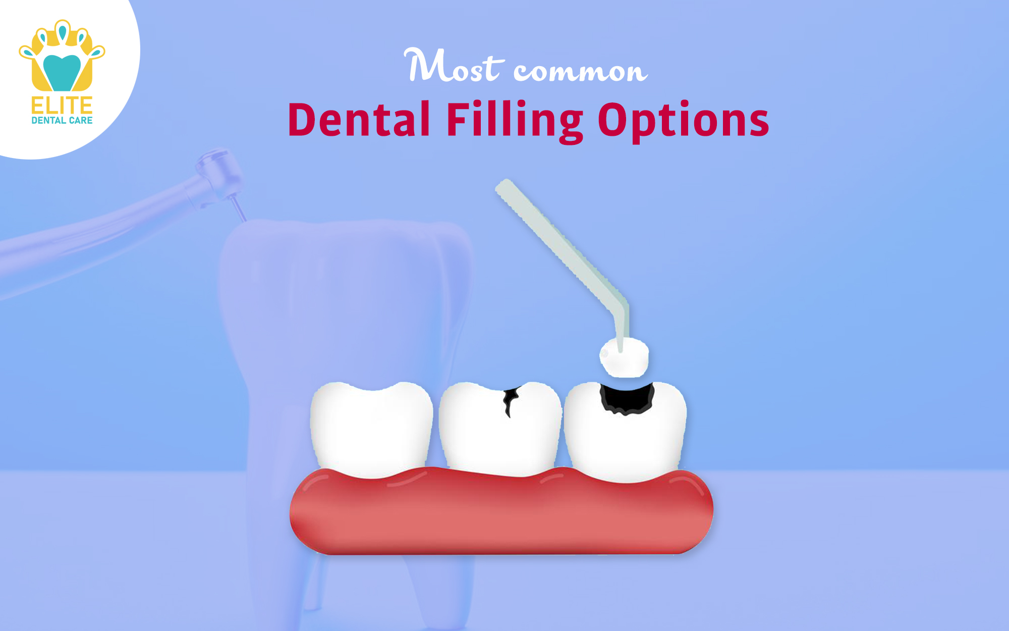 COMMON TYPES OF DENTAL FILLINGS