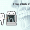3 Types of Dental Xray