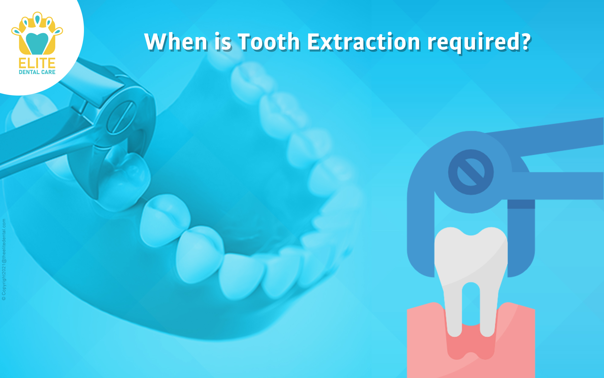 When is Tooth Extraction required?