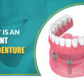 What is an Implant Overdenture?