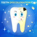 What are the Causes of Teeth Discoloration?