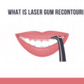 What is laser gum recontouring?