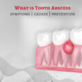 What are tooth abscess symptoms, causes, and prevention?