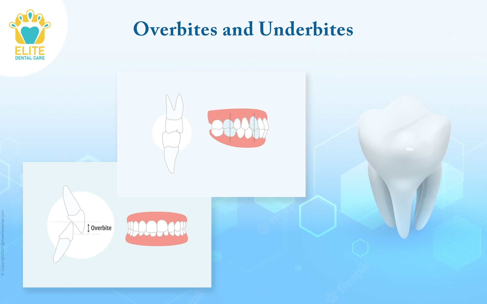 Overbites and Underbites