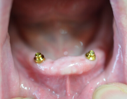IMPLANT RETAINED DENTURES