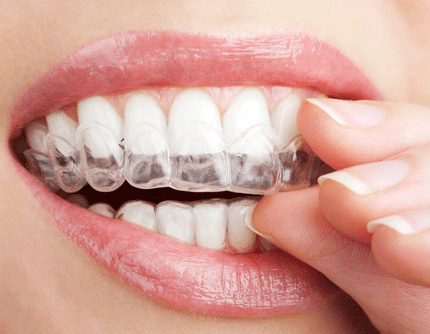 INVISALIGN