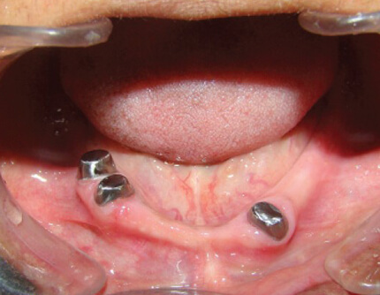 OVERDENTURE