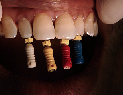 ROOT CANAL