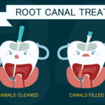 Root Canal Treatment (Endodontic Therapy)