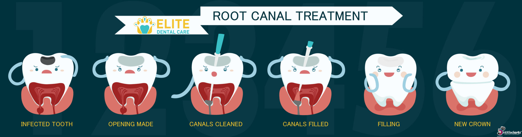 Root Canal Treatment (Endodontic Therapy)