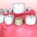 Dental Crown: Things you Should Know About