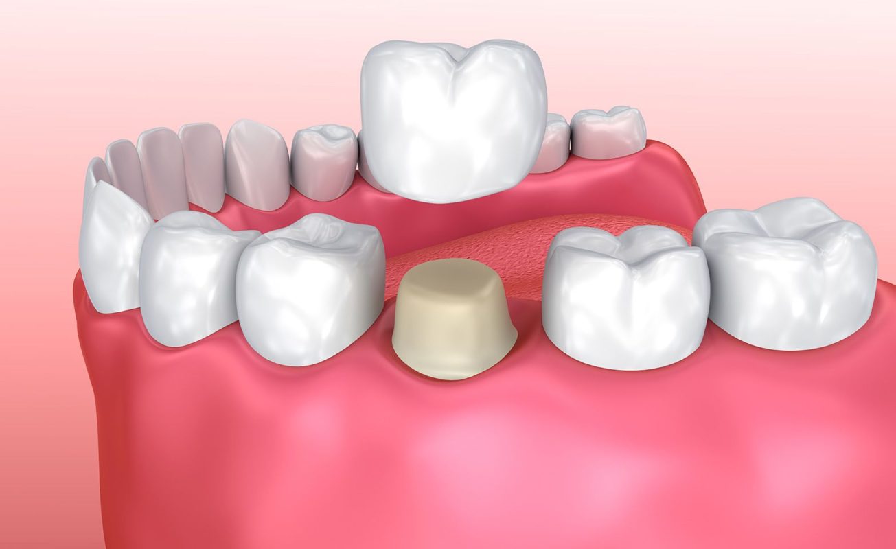 dental crown - elite dental care tracy
