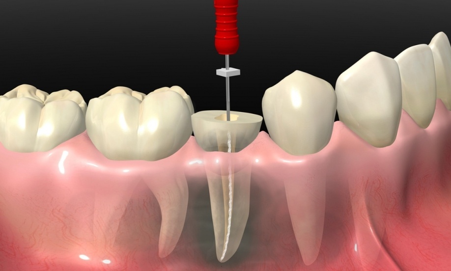 Tips to Follow After Root Canal Treatment - Elite Dental Care Tracy