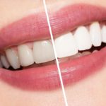 What’s Best for Teeth Whitening