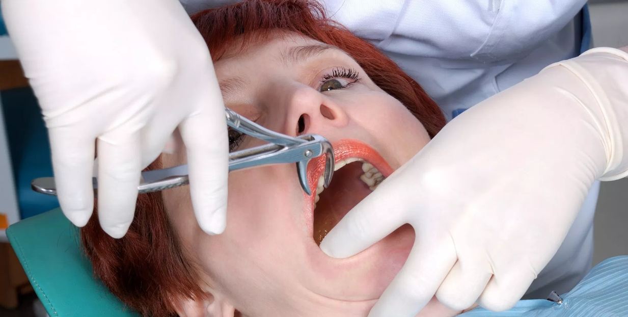How Long Does It Take to Recover from a Tooth Extraction