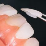 How are Veneers Used in Dentistry