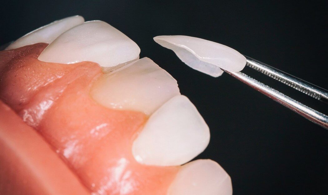 How are Veneers Used in Dentistry