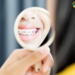 Care Four Your Braces Better | Braces Care Instructions – Elite Dental Care in Tracy