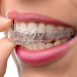 What You Should Expect in Living with Invisalign