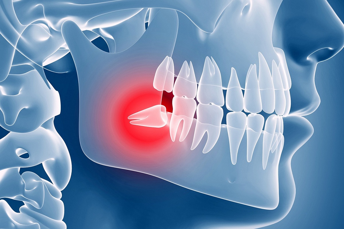 Wisdom Teeth Removal – 5 Awesome Tips for Recovery