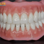 Bio Functional Prosthetic System(BPS) Dentures Fixing – Elite Dental Care Tracy