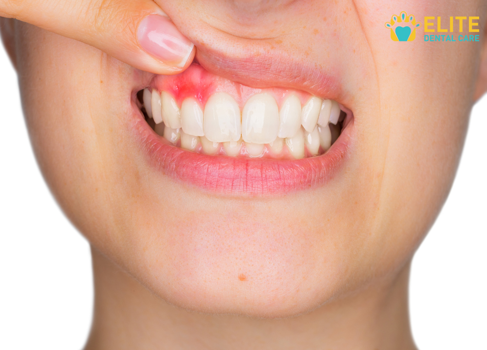 Common Causes of Sensitive Teeth - Elite Dental Care