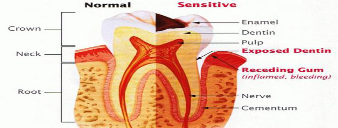 Common Causes of Sensitive Teeth3