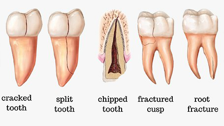 Cracked tooth - causes and treatment methods