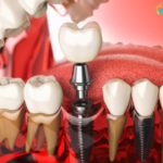 Dental Implant And How Crucial Replacing Teeth – Elite Dental Care Tracy